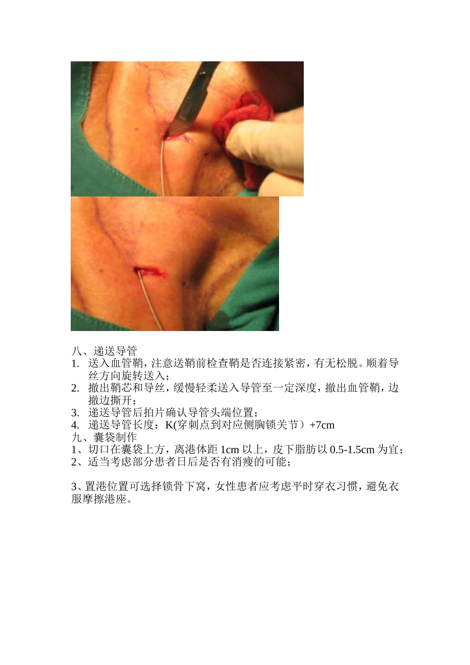 植入式静脉输液港植入流程穿刺法.doc_第3页