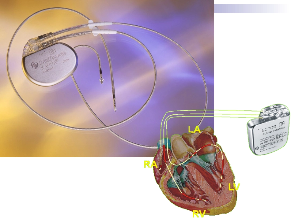 心脏起搏器ppt.ppt_第1页