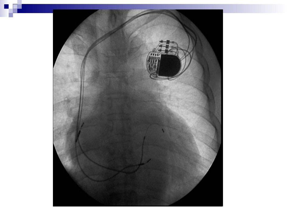 心脏起搏器ppt.ppt_第2页