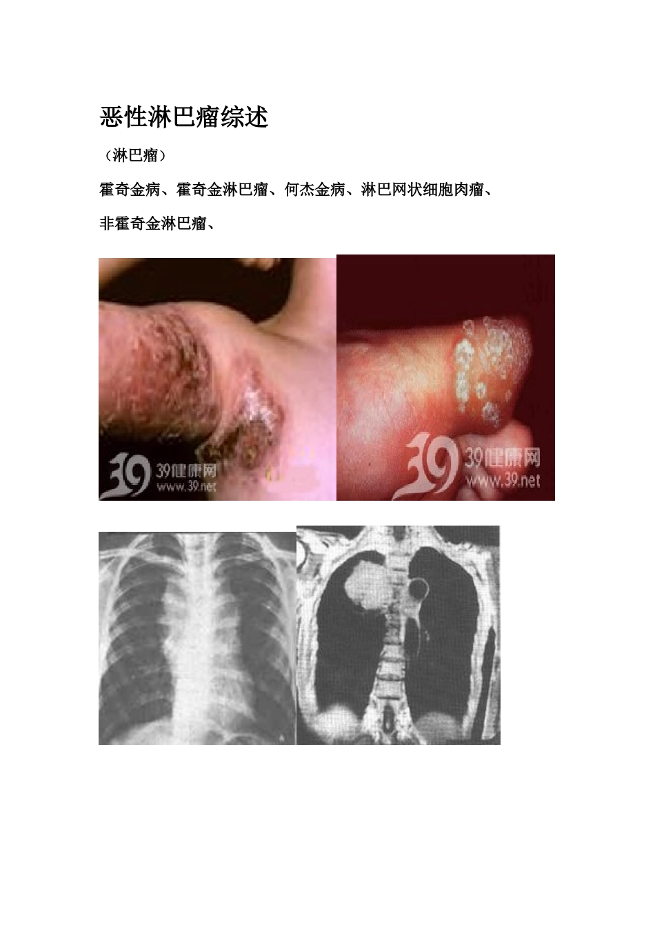 恶性淋巴瘤综述.doc_第1页