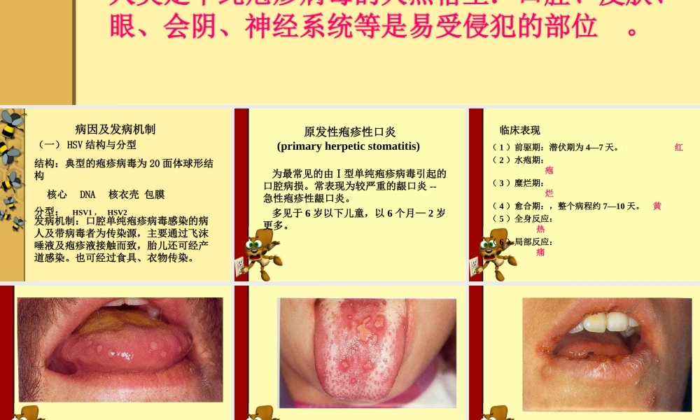 口腔单纯疱疹.ppt