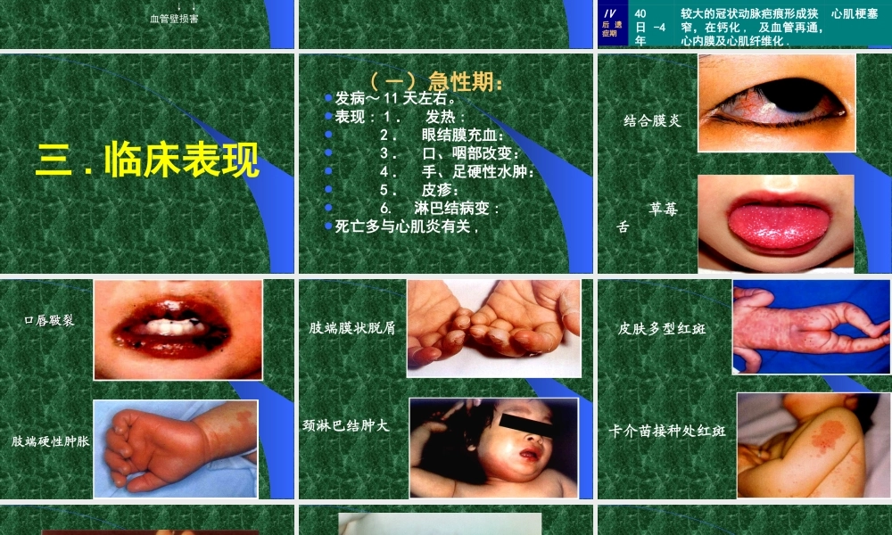 川崎病的诊治.ppt