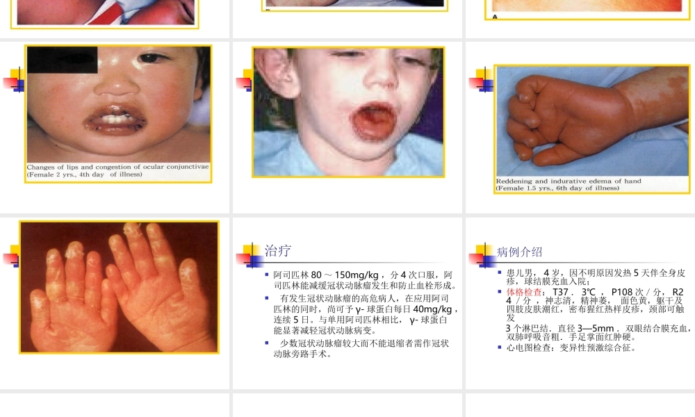 川崎病教学查房新.ppt