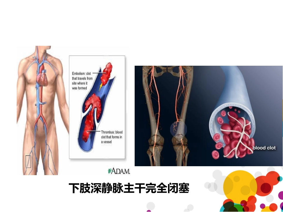 下肢深静脉血栓诊疗.ppt_第3页