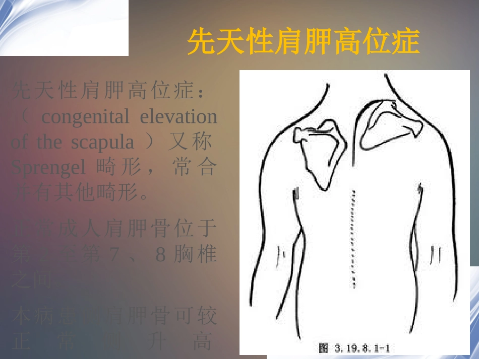 先天性高肩胛症.pptx_第2页