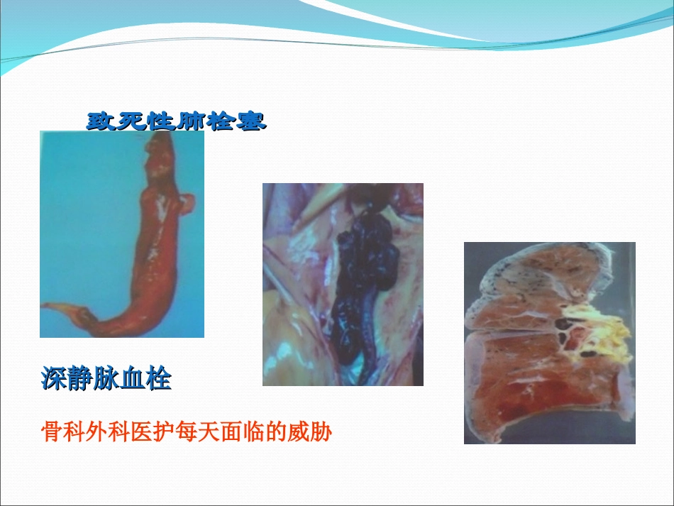 下肢深静脉栓塞.ppt_第3页