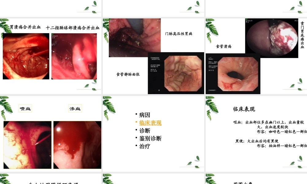 上消化道出血.pptx