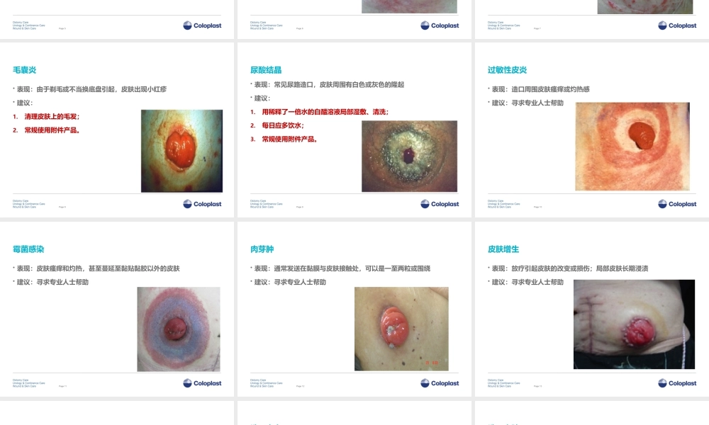3造口并发症介绍.pptx