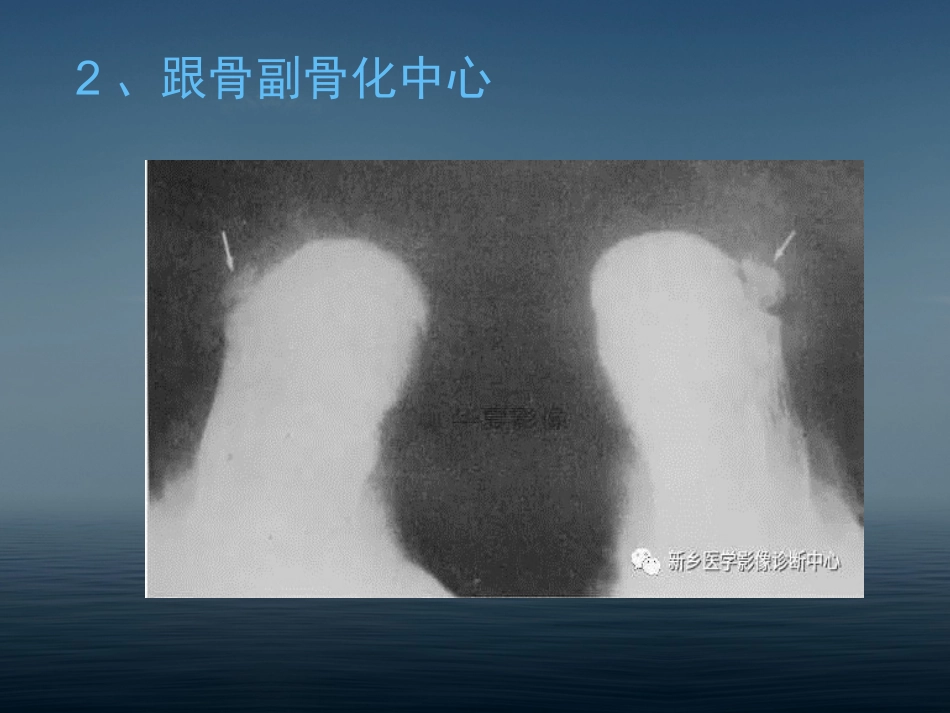 下肢骨影像常见变异.ppt_第3页