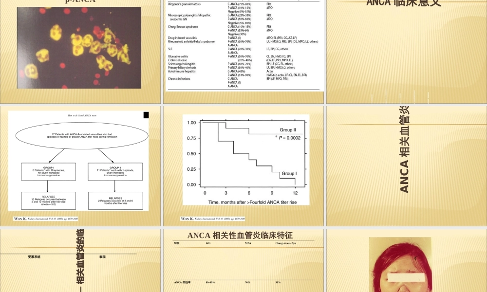 ANCA相关性血管炎诊治.ppt