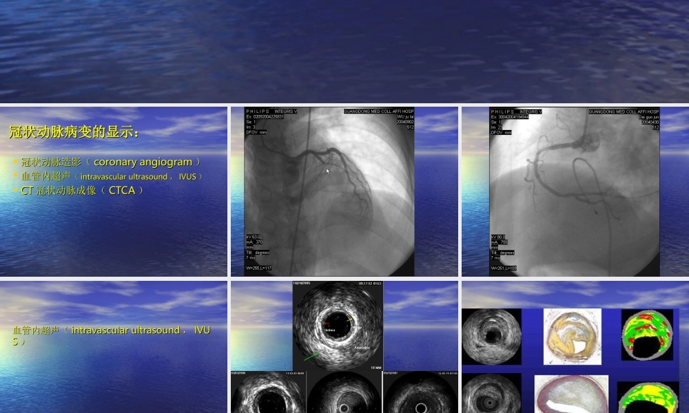 64排螺旋CT的冠状动脉成像.ppt