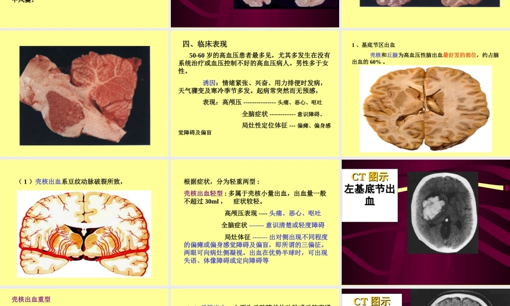7.脑出血.ppt