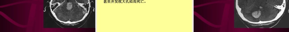 7.脑出血.ppt