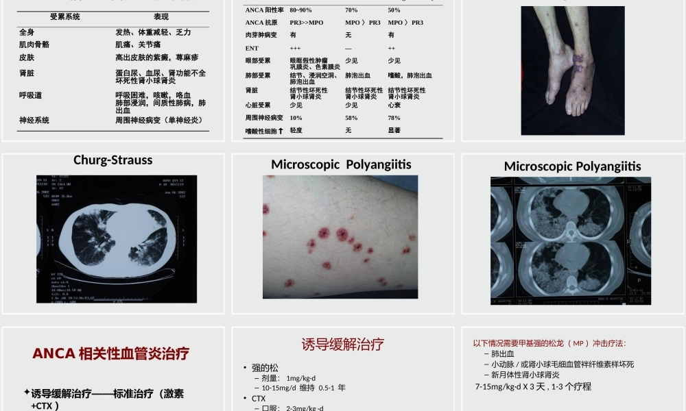 ANCA相关性小血管炎诊治进展.pptx