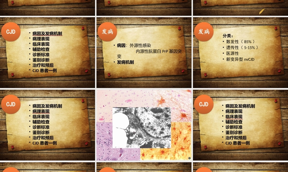 CJD介绍及病例.ppt