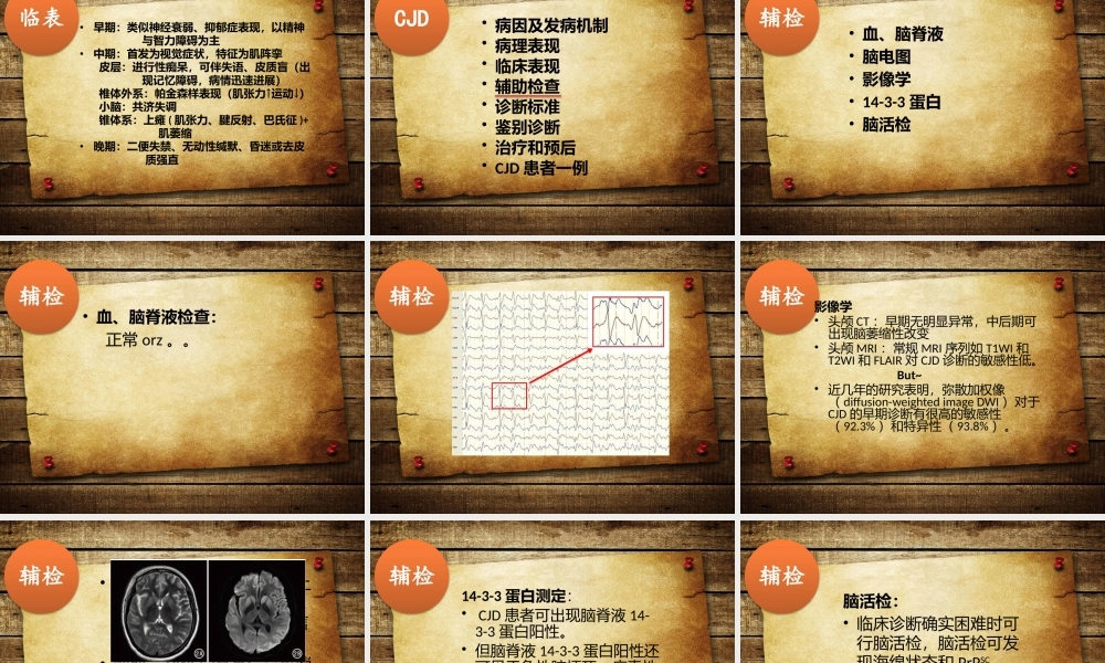 CJD介绍及病例.ppt