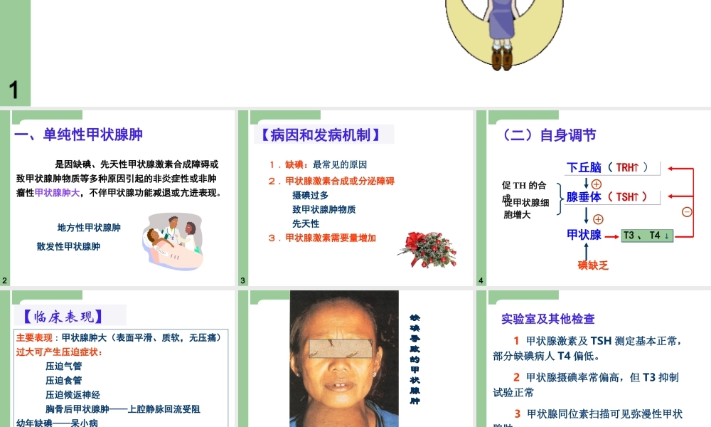 一单纯性甲状腺肿.ppt
