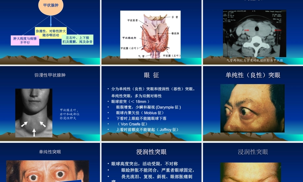 【甲亢】详解.ppt