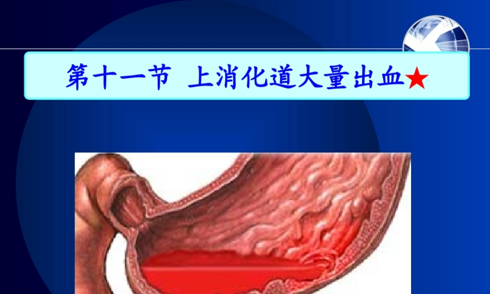 上消化道出血(12).ppt