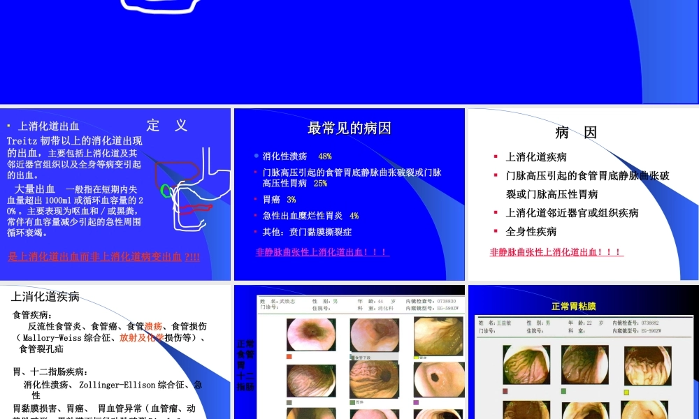 上消化道出血的处理(武希润).ppt