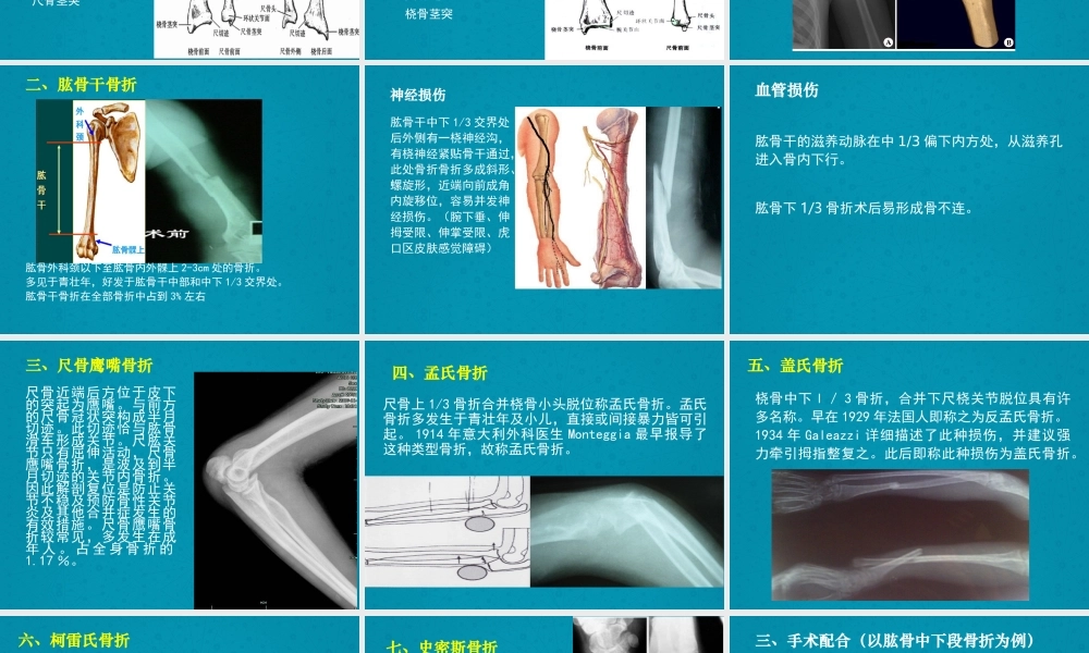 上肢骨折及手术配合.ppt