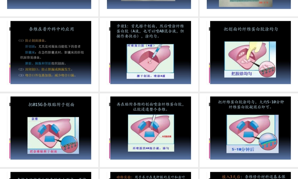 可吸收性聚乙醇酸修补材料(普外科).ppt