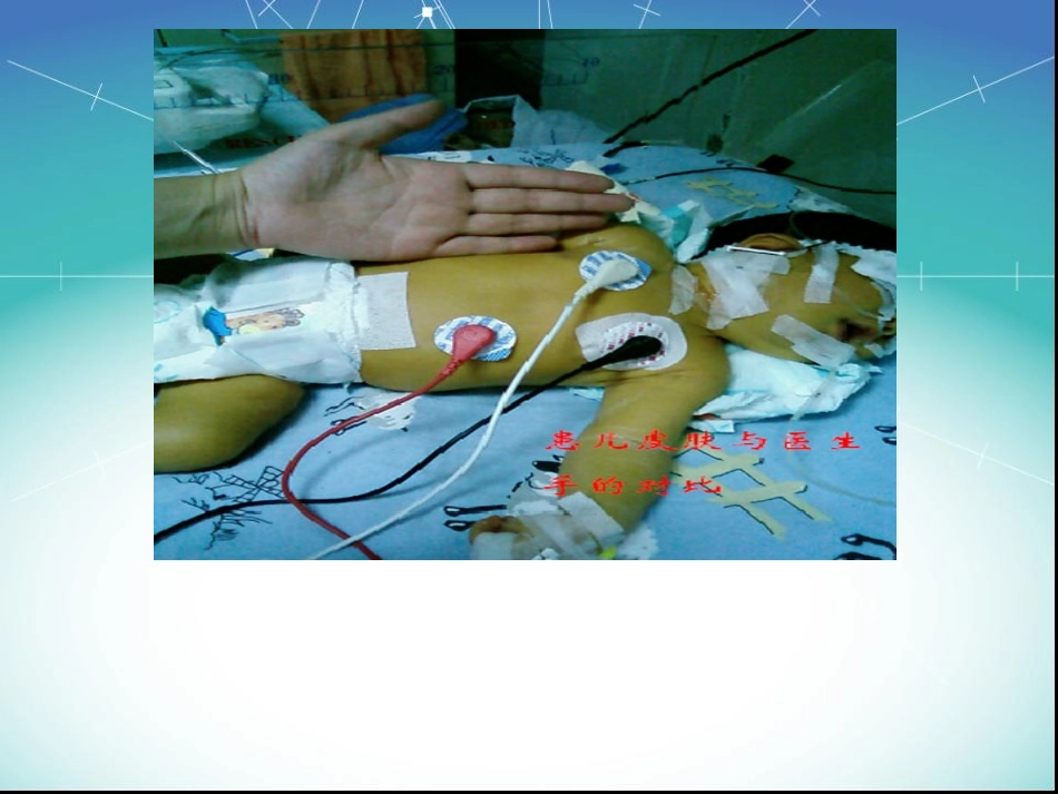 新生儿溶血病-(1).ppt_第1页