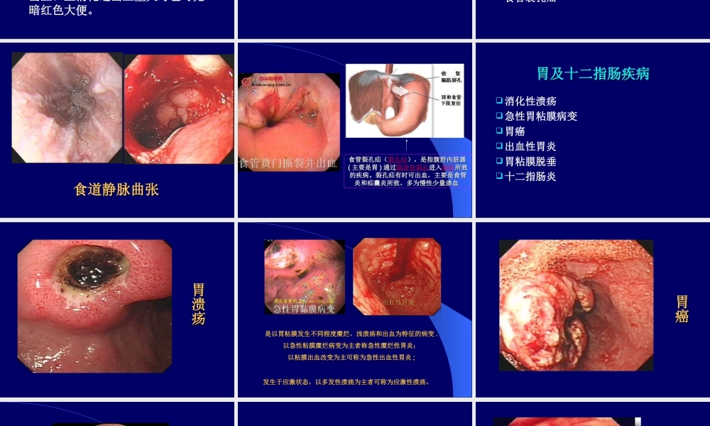 呕血黑便-(NXPowerLite).ppt