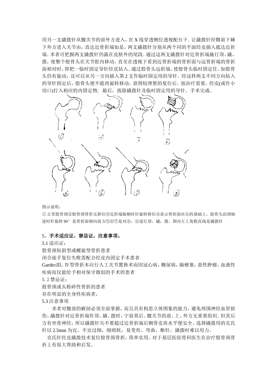 克氏针撬拨技术在闭合复位股骨颈骨折中的运用.doc_第2页