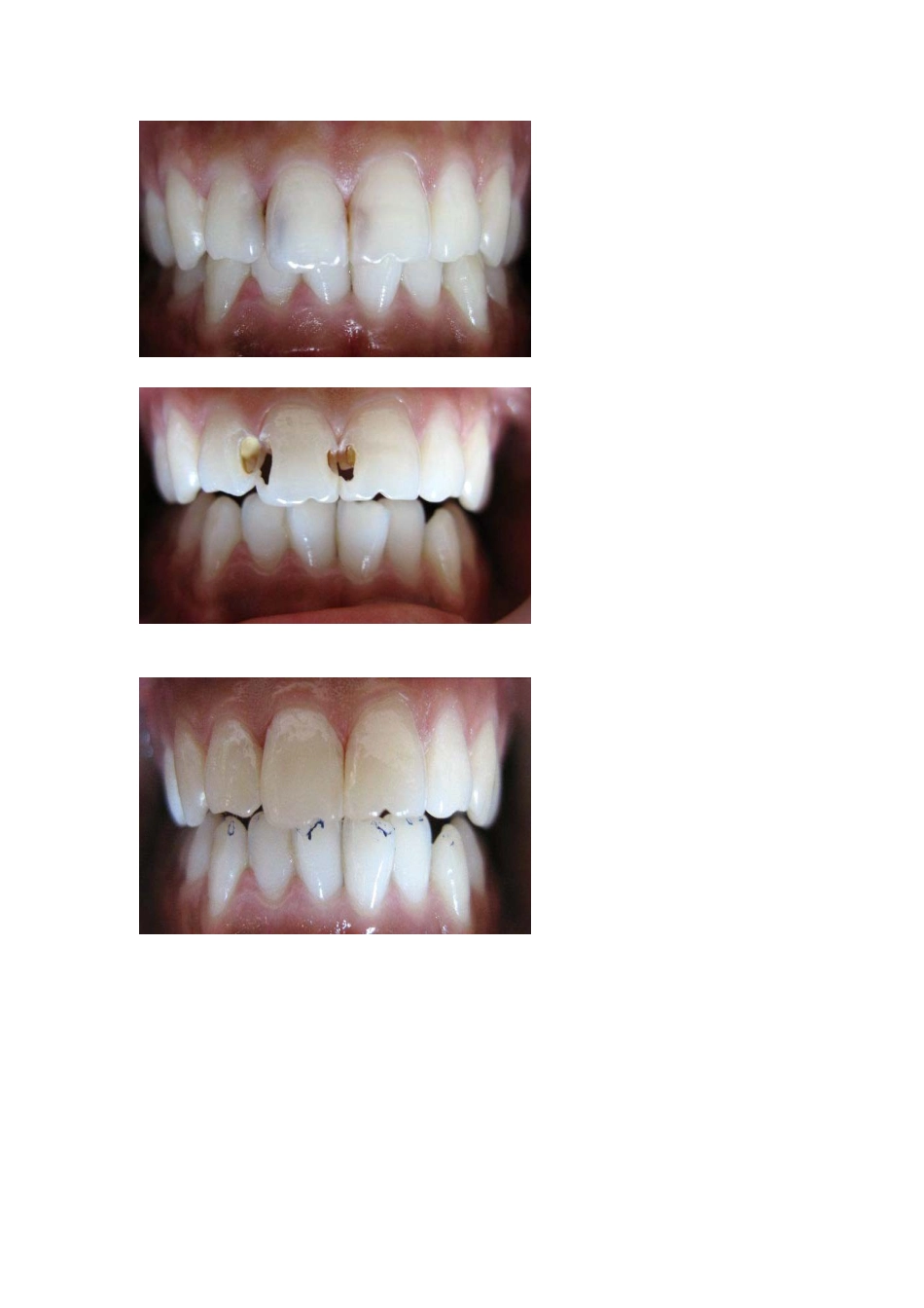 光固化树脂充填术.doc_第2页