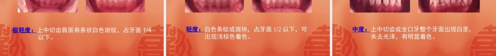变色牙与漂白术.ppt