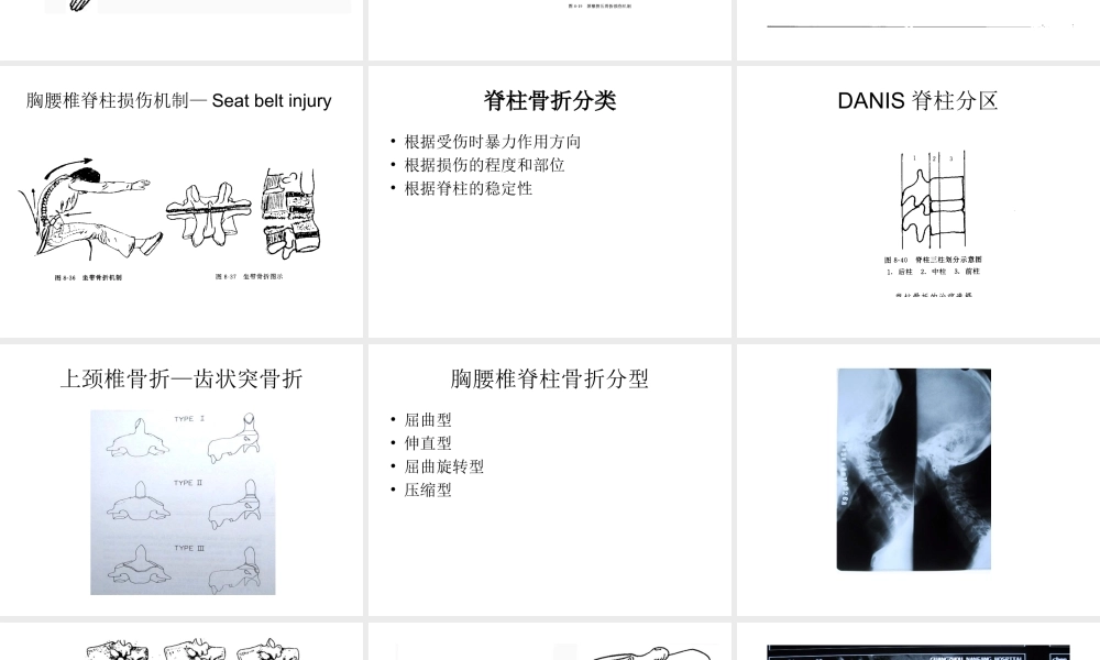 6.4第六章-第四节躯干骨折.ppt