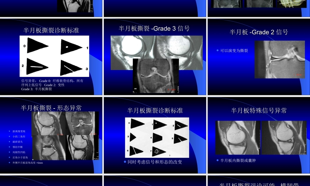MRI膝关节.ppt