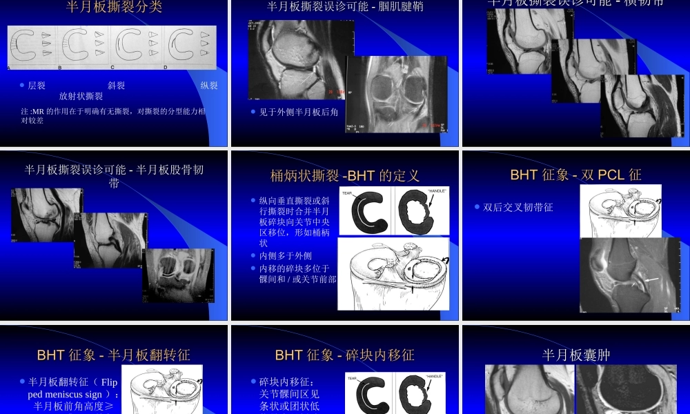 MRI膝关节.ppt