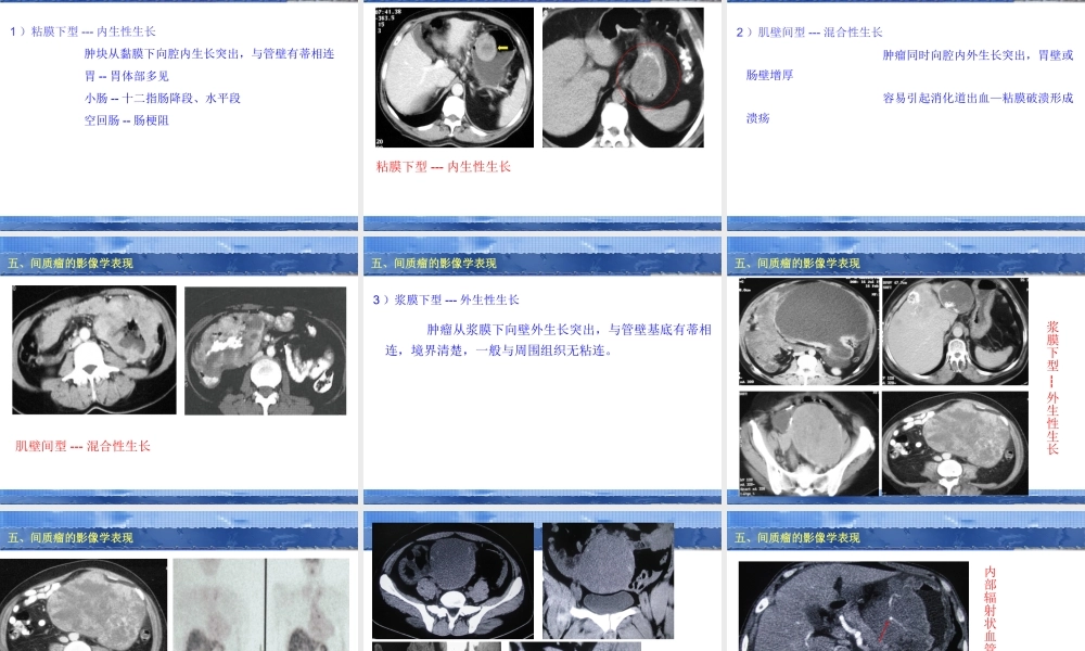 58-胃肠道间质瘤的影像学表现.ppt