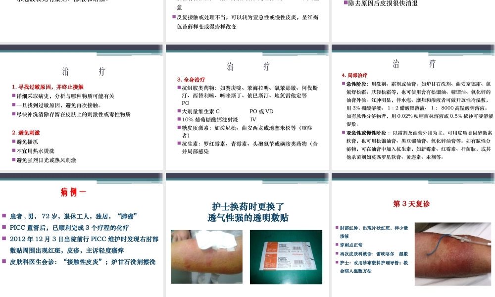 严重的接触性皮炎的处理..精讲.ppt
