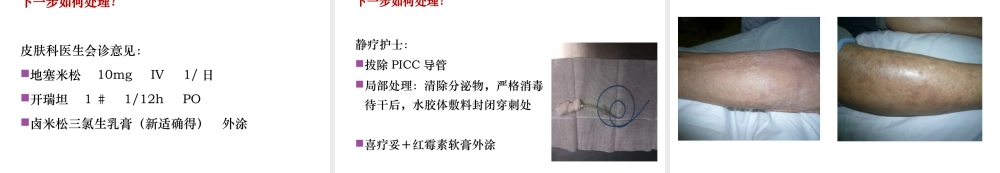 严重的接触性皮炎的处理..精讲.ppt