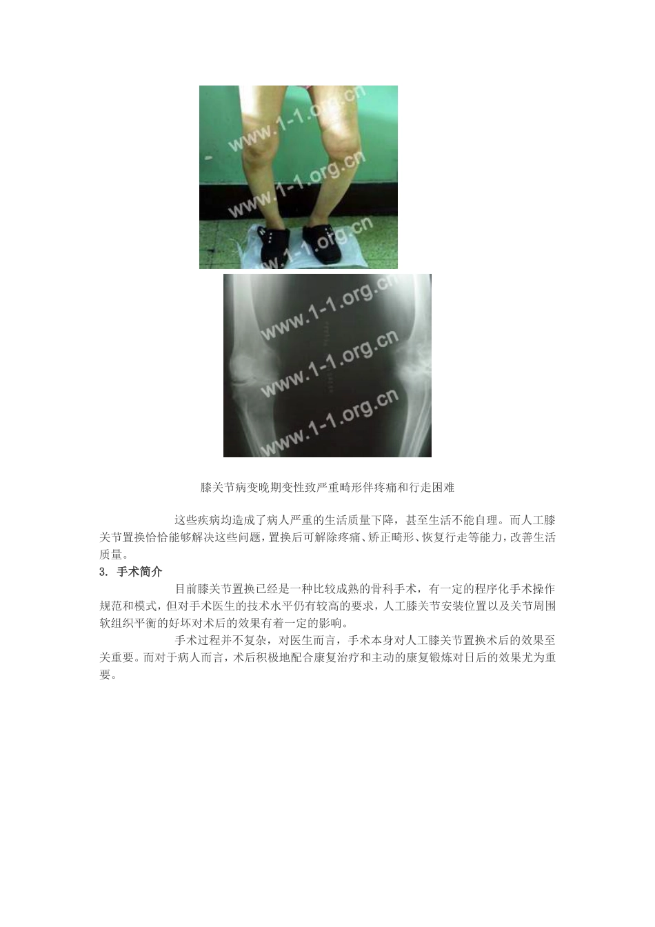 人工膝关节置换术后康复指南.doc_第3页