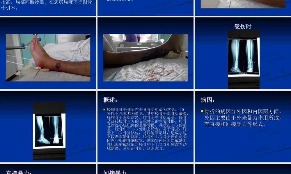 业务查房-(胫腓骨骨折).ppt