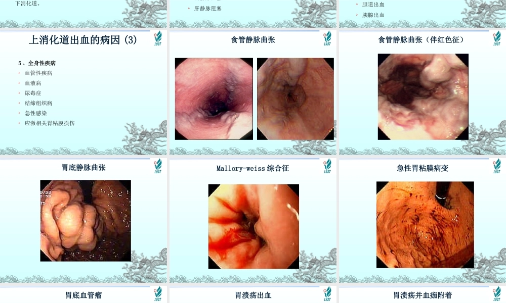上消化道出血---网络版.ppt