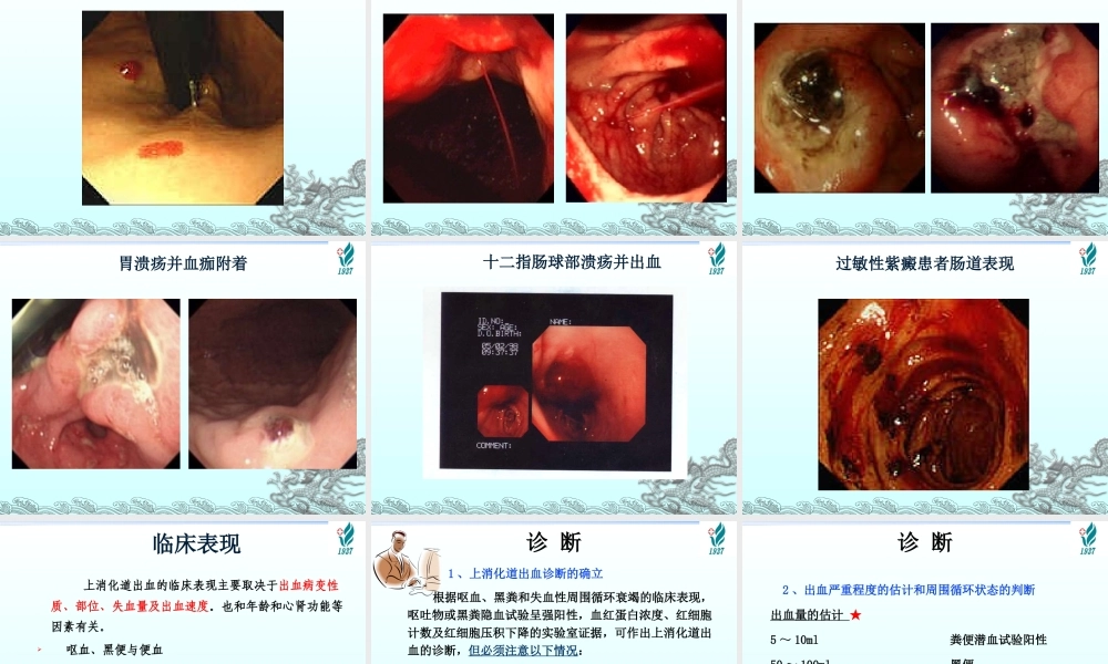上消化道出血---网络版.ppt
