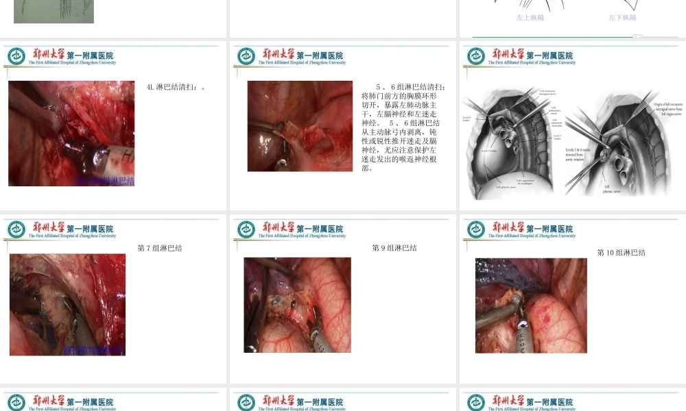 VATS左侧肺癌根治术中的淋巴结清扫---胸外科.ppt