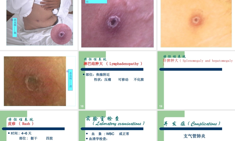 中山大学恙虫病分析.ppt