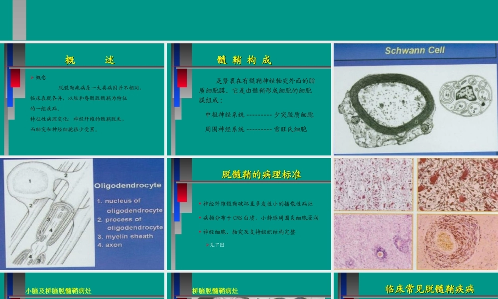 中枢神经系统脱髓壳病(详细).ppt