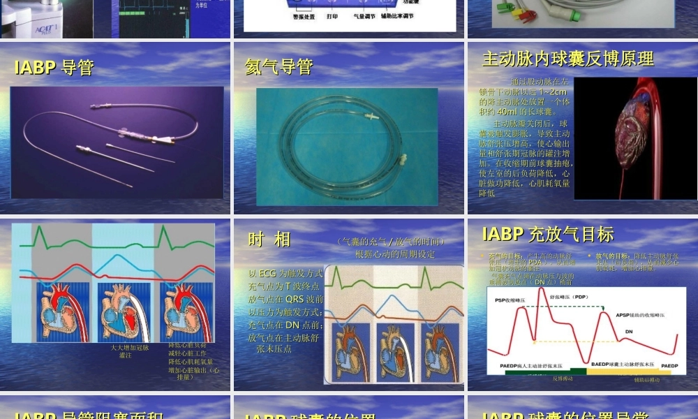 主动脉内球囊反博概述.ppt