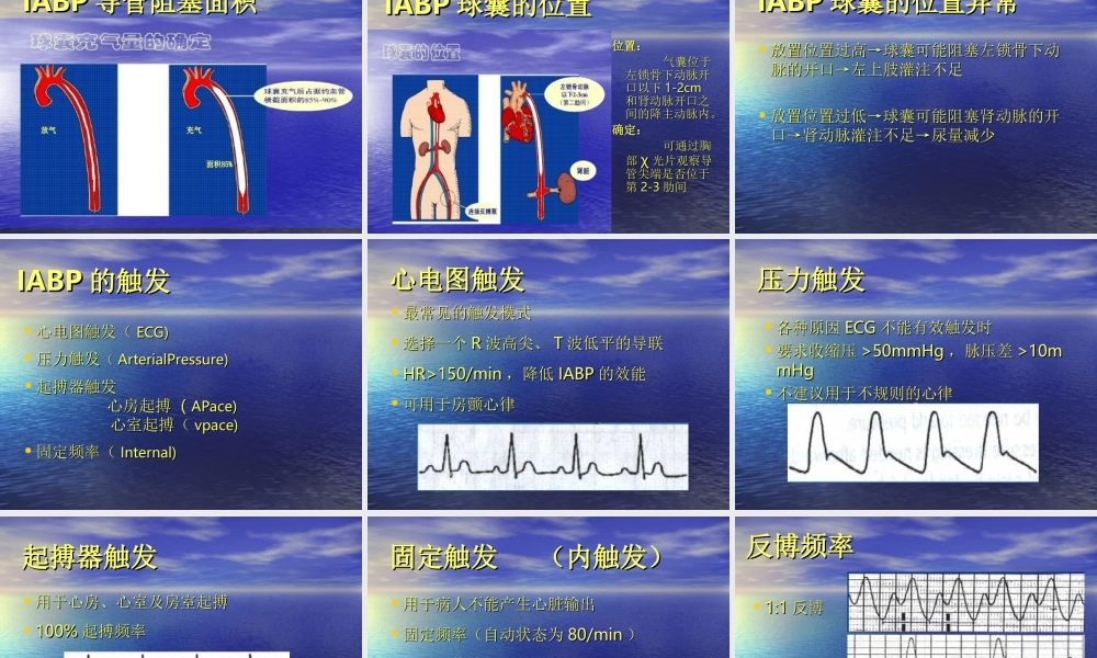 主动脉内球囊反博概述.ppt