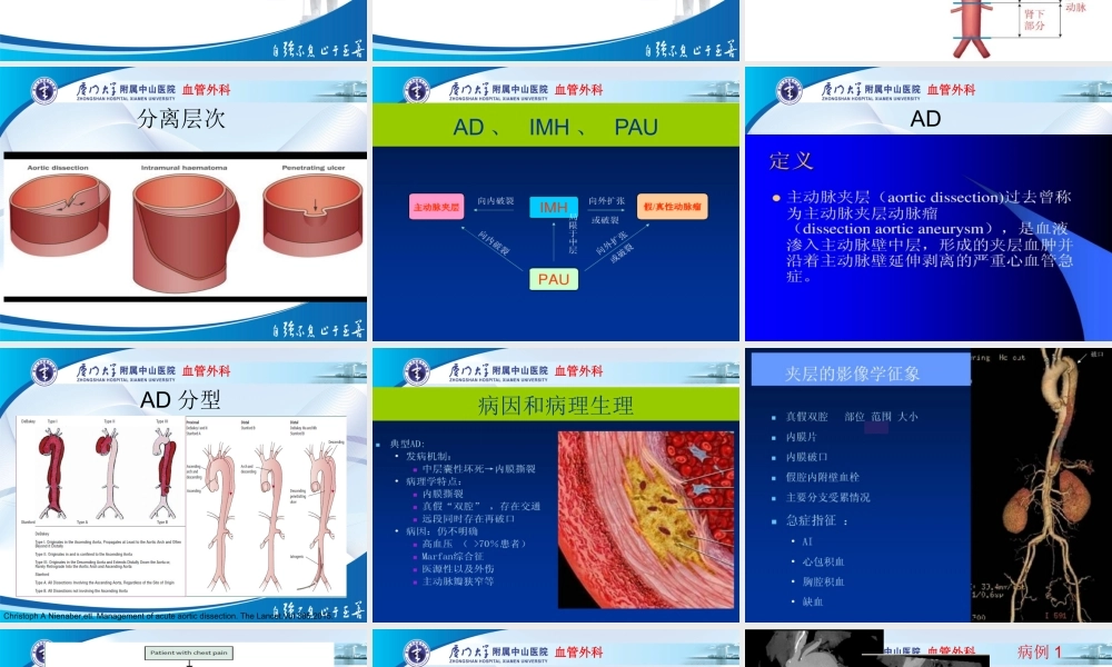 主动脉壁间血肿与穿透性溃疡.ppt