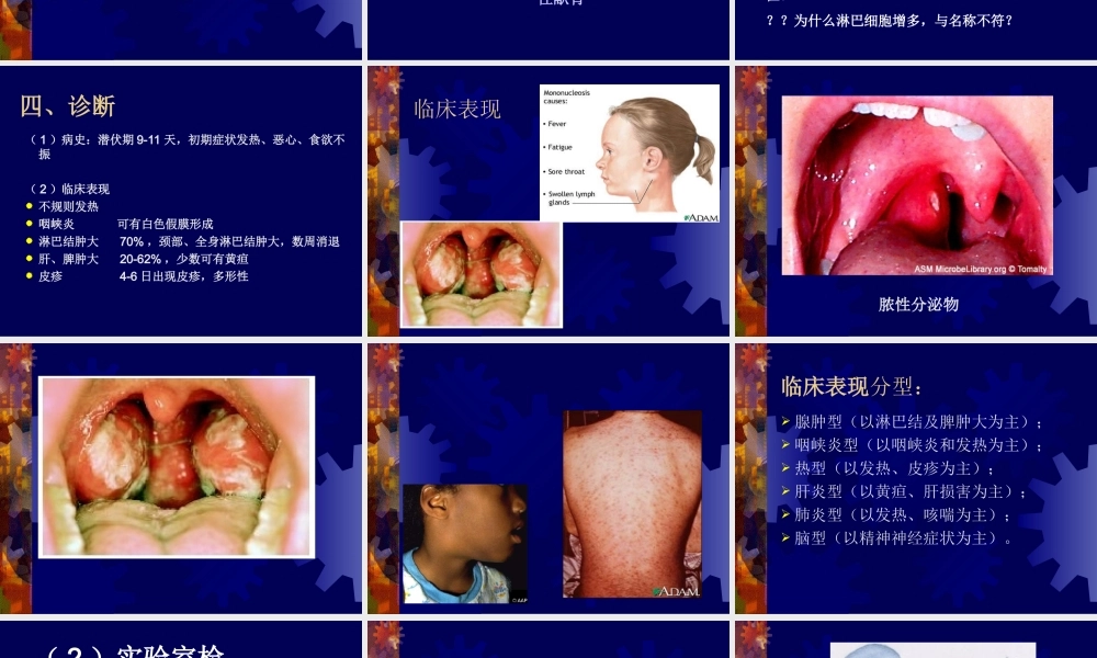 传染性单核细胞增多症2012级.ppt