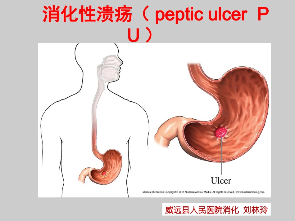 消化性溃疡刘林玲.ppt_第1页