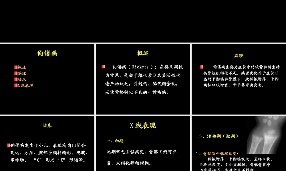 佝偻病影像.ppt